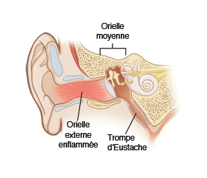 Oreille moyenne, oreille externe enflammée, trompe d'Eustache